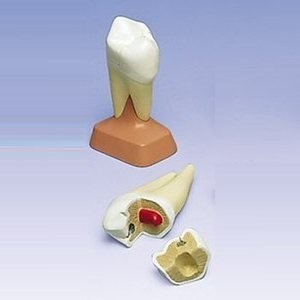 UPPER TWIN-ROOT MOLAR WITH CAVITIES , 2 PART